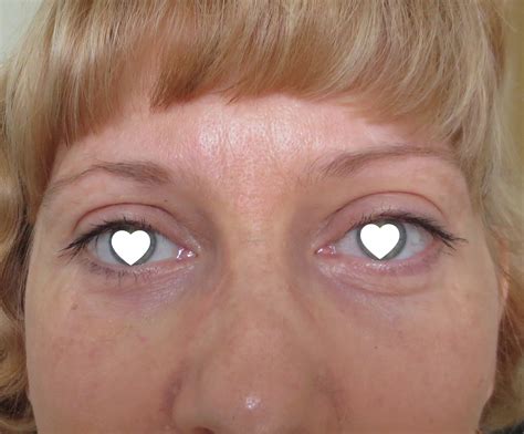 lazernaya-blefaroplastika-v-moskve-2