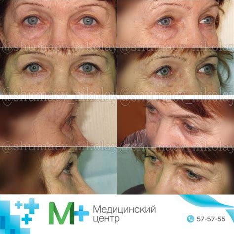 massazh-vek-posle-blefaroplastiki-tehniki