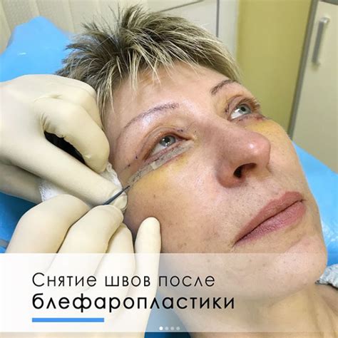mikrotoki-posle-blefaroplastiki-kak-provoditsya-protsedura-otzyvy