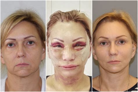 neudachnaya-blefaroplastika-vek-foto-do-i-posle-kak-izbezhat