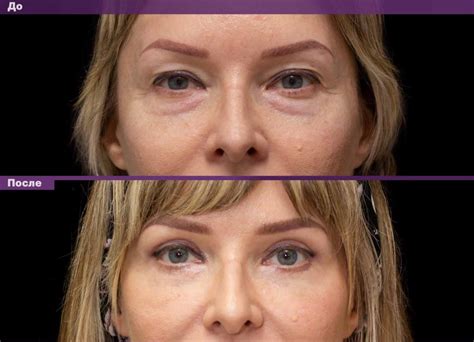 nitevaya-blefaroplastika-vek-kak-proishodit-korrektsiya-otzyvy-foto-do-i-posle