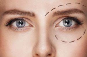 pamyatka-patsientu-pered-blefaroplastikoy