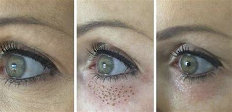 plazmennaya-blefaroplastika-tsena-apparat