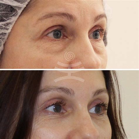 pokazaniya-k-provedeniyu-blefaroplastiki-chto-nuzhno-znat