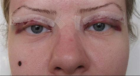 povtornaya-blefaroplastika-otzyvy-kogda-nuzhna-foto-do-i-posle