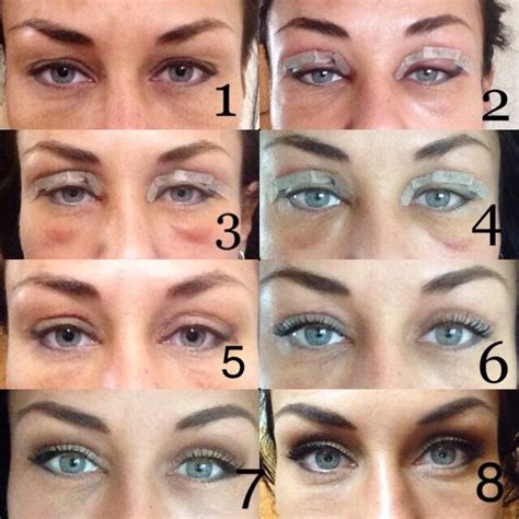 reabilitatsiya-posle-blefaroplastiki-po-dnyam-foto