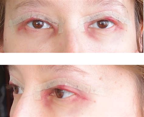 rubtsy-posle-blefaroplastiki-shlifovka-chem-mazat-lechenie