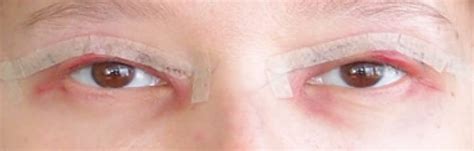 shramy-posle-blefaroplastiki-2