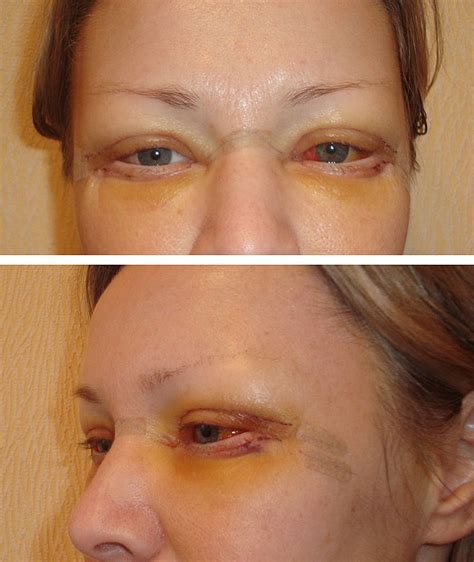 shvy-posle-blefaroplastiki-snyatie-foto-chem-mazat