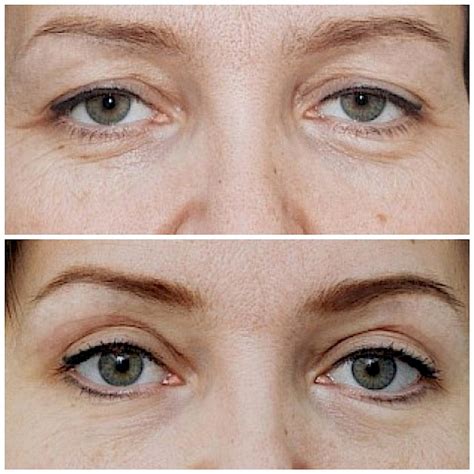 sovremennye-metody-blefaroplastiki-vidy-pokazaniya