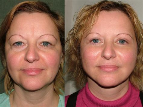 stoit-li-delat-blefaroplastiku-komu-nuzhna-korrektsiya-verhnih-i-nizhnih-vek