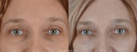 transkonyuktivalnaya-blefaroplastika-v-moskve