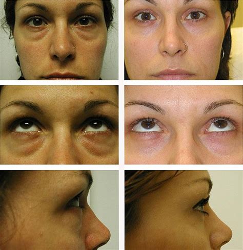 transkonyuktivalnaya-blefaroplastika-foto-tsena-oslozhneniya