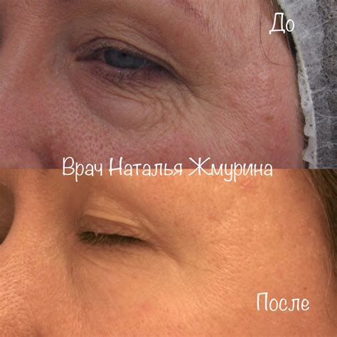 udalenie-meshkov-pod-glazami-lazerom-tsena-otzyvy-foto-do-i-posle