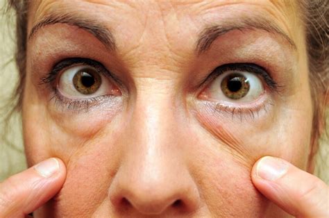 uplotnenie-posle-blefaroplastiki-prichiny