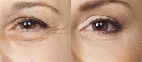 v-kakoe-vremya-goda-luchshe-delat-blefaroplastiku-rekomendatsii