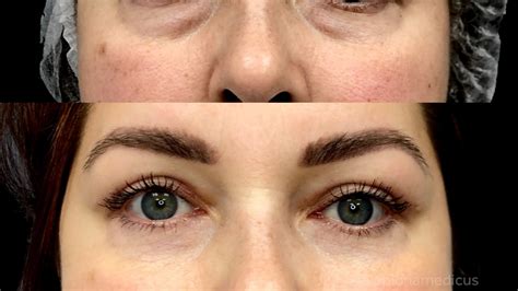 verhnyaya-blefaroplastika-osobennosti-protsedury