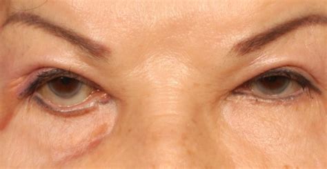 vyvorot-veka-posle-blefaroplastiki-foto-otzyvy