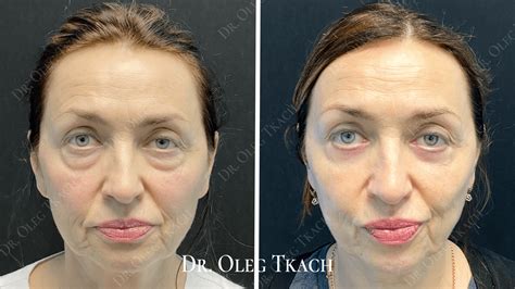 zhirosohranyayuschaya-blefaroplastika-kak-vypolnyayut