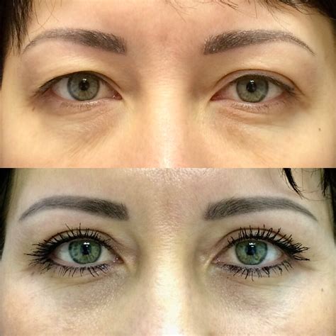 blefaroplastika-vek-otzyvy-tsena-foto-do-i-posle-part-3