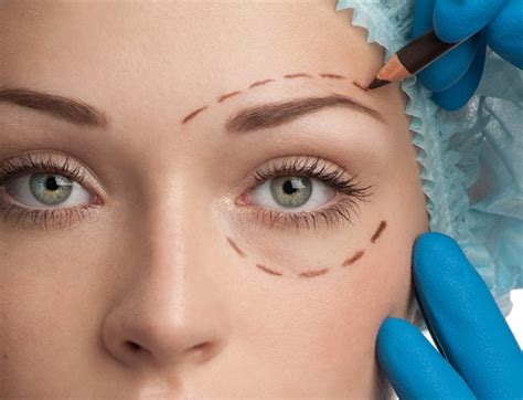 endoskopicheskaya-blefaroplastika-kak-vypolnyayut